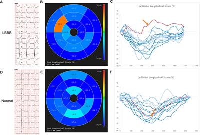 Recruitment of the cardiac conduction system for optimal resynchronization therapy in failing heart